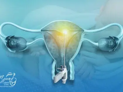 عملية استئصال الرحم بالمنظار