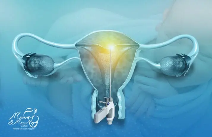 عملية استئصال الرحم بالمنظار
